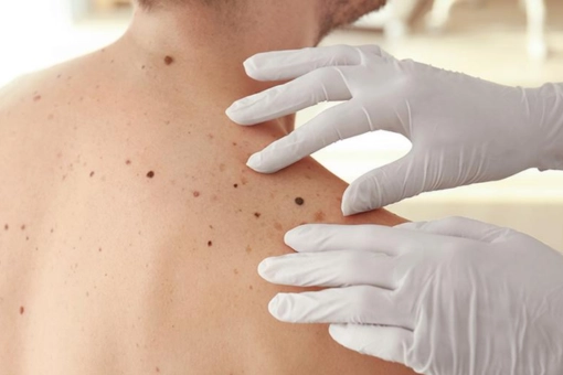 ¿Tienes verrugas en manos, pies, rostro o cualquier parte del cuerpo?