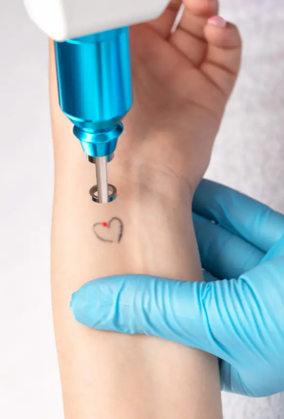 Eliminación de Tatuajes